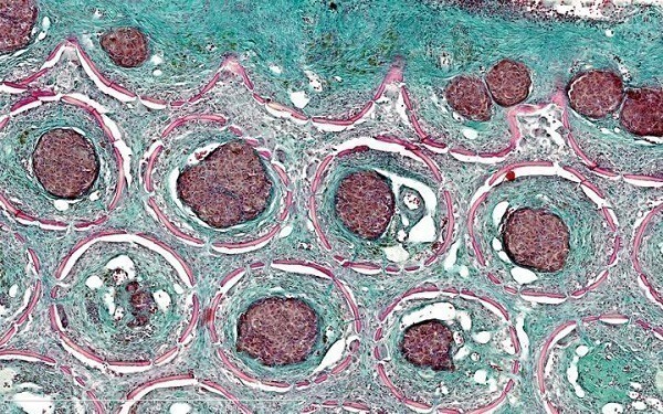 Type 1 diabetes behandelen met implantaten